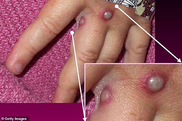 Monkeypox is a rare viral infection which causes unusual rashes or lesions (shown in a handout provided by the Centers for Disease Control and Prevention (CDC) in the US
